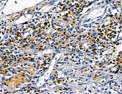 PTIP Antibody - DF13814 at 1/100 staining human esophageal cancer by IHC-P.