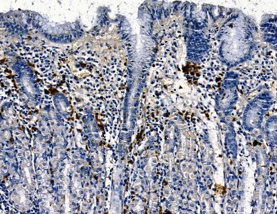 MKRN1 Antibody - DF13815 at 1/100 staining human pancreatic cancer and para-carcinoma tissue by IHC-P.