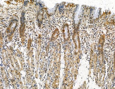 INT11 Antibody - DF13817 at 1/100 staining human pancreatic cancer and para-carcinoma tissue by IHC-P.
