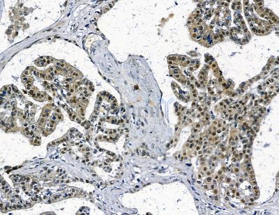 INT11 Antibody - DF13817 at 1/100 staining human liver cancer by IHC-P.