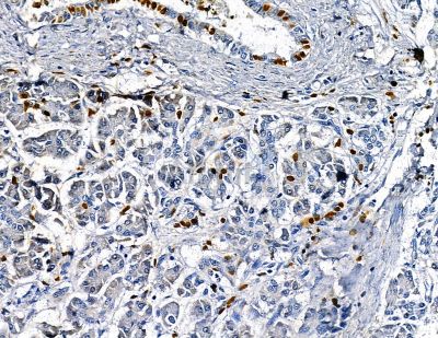 Interleukin 34 Antibody - DF13820 at 1/100 staining human gastric cancer and para-carcinoma tissue by IHC-P.