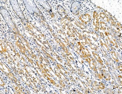 Interleukin 34 Antibody - DF13820 at 1/100 staining human colorectal cancer and para-carcinoma tissue by IHC-P.
