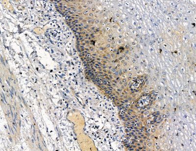HIP1R Antibody - DF13824 at 1/100 staining human esophageal cancer and para-carcinoma tissue by IHC-P.