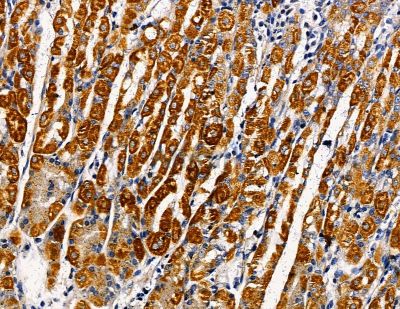 HIP1R Antibody - DF13824 at 1/100 staining human pancreatic cancer and para-carcinoma tissue by IHC-P.