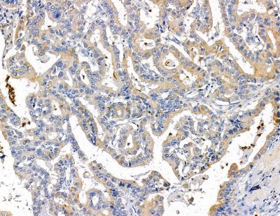 GPCR TGR5 Antibody - DF14067 at 1/100 staining human liver cancer by IHC-P.