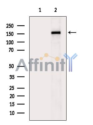 JAD1D Antibody - Western blot analysis of JAD1D expression in human prostate cancer ,The lane on the left was treated with the antigen-specific peptide.