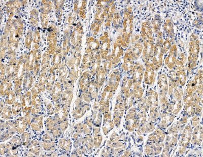 USP10 Antibody - DF8061 at 1/100 staining human pancreatic cancer and para-carcinoma tissue by IHC-P.