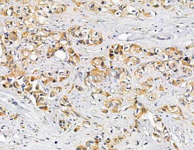 USP10 Antibody - DF8061 at 1/100 staining human lung cancer by IHC-P.