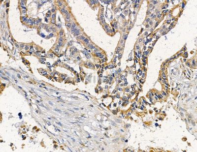 USP10 Antibody - DF8061 at 1/100 staining human liver cancer by IHC-P.