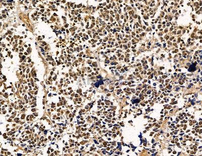 Ubinuclein Antibody - DF8873 at 1/100 staining human colorectal cancer by IHC-P.