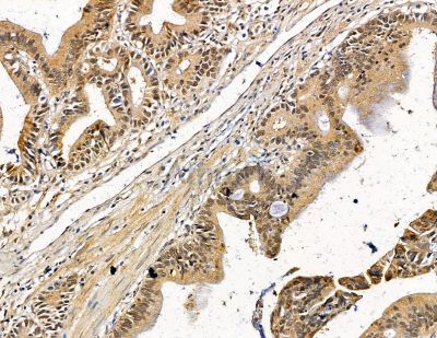 Ubinuclein Antibody - DF8873 at 1/100 staining human pancreatic cancer by IHC-P.