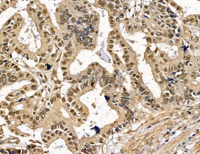 Ubinuclein Antibody - DF8873 at 1/100 staining human liver cancer by IHC-P.