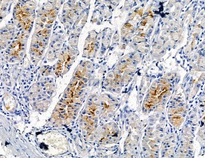 Collagen VIII  alpha 2 Antibody - DF8903 at 1/100 staining human pancreatic cancer and para-carcinoma tissue by IHC-P.