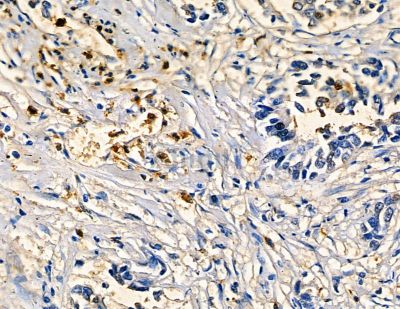 Cytochrome P450 4F3 Antibody - DF8927 at 1/100 staining human pancreatic cancer by IHC-P.