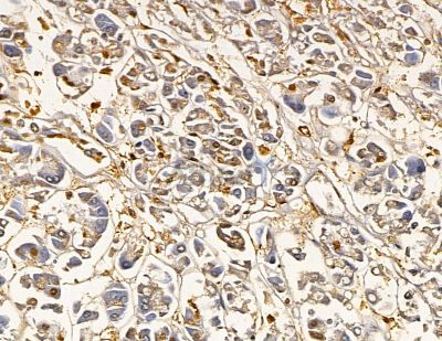 HLA-DMA Antibody - DF9572 at 1/100 staining human gastric cancer and para-carcinoma tissue by IHC-P.