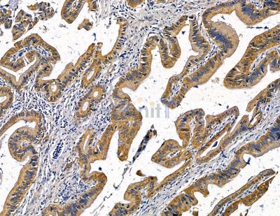 BTF3L2 Antibody - DF9972 at 1/100 staining human pancreatic cancer by IHC-P.