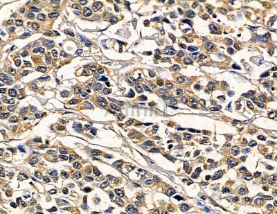 GDF 5 Antibody - DF13842 at 1/100 staining human prostate cancer by IHC-P.
