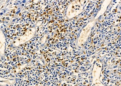 RBM24 Antibody - DF13843 at 1/100 staining human esophageal cancer by IHC-P.