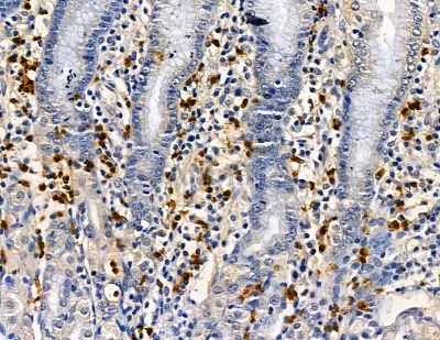 RBM24 Antibody - DF13843 at 1/100 staining human pancreatic cancer and para-carcinoma tissue by IHC-P.