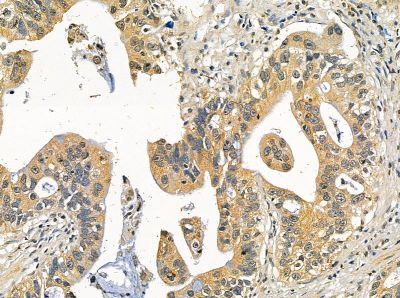 TRIM72 Antibody - DF14098 at 1/100 staining human gastric cancer by IHC-P.