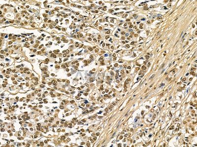 CHD3 Antibody - DF14105 at 1/100 staining human prostate cancer by IHC-P.