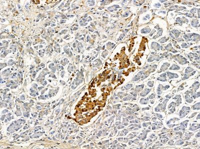 STOML3 Antibody - DF14123 at 1/100 staining human pancreatic cancer by IHC-P.