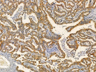 AGXT Antibody - DF14126 at 1/100 staining human prostate cancer and para-carcinoma tissue by IHC-P.