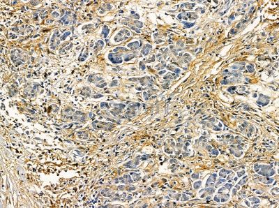 FRYL Antibody - DF14139 at 1/100 staining human gastric cancer by IHC-P.