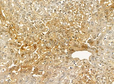 RDH5 Antibody - DF14183 at 1/100 staining human mammary cancer and para-carcinoma tissue by IHC-P.
