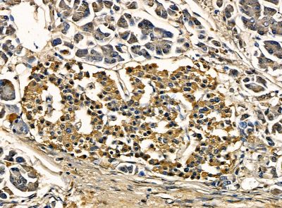 SNX33 Antibody - DF14186 at 1/100 staining human pancreatic cancer by IHC-P.