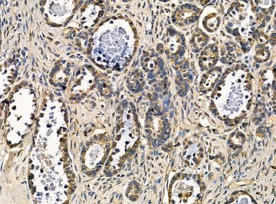 alpha COP I Antibody - DF14201 at 1/100 staining human ovarian cancer by IHC-P.