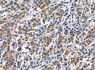 RHOJ Antibody - DF14204 at 1/100 staining human gastric cancer by IHC-P.
