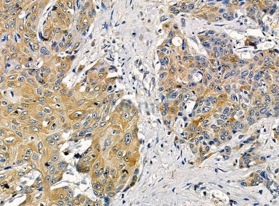 KPNA6 Antibody - DF14206 at 1/100 staining human esophageal cancer by IHC-P.