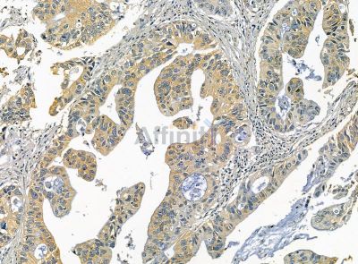CLEC12A Antibody - DF14229 at 1/100 staining human pancreatic cancer by IHC-P.