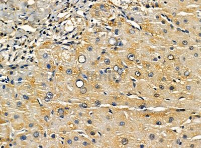 C1orf64 Antibody - DF14267 at 1/100 staining human prostate cancer and para-carcinoma tissue by IHC-P.