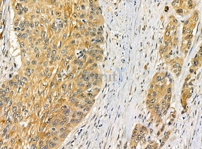 C1orf114 Antibody - DF14271 at 1/100 staining human esophageal cancer and para-carcinoma tissue by IHC-P.