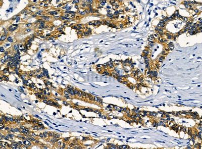 KIAA1522 Antibody - DF14276 at 1/100 staining human prostate cancer by IHC-P.