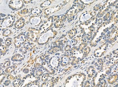 Amelotin Antibody - DF14285 at 1/100 staining human prostate cancer by IHC-P.