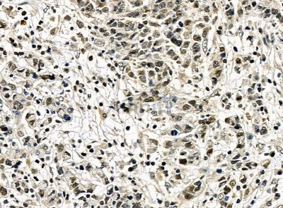 C11orf51 Antibody - DF14288 at 1/100 staining human gastric cancer by IHC-P.