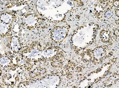 C11orf51 Antibody - DF14288 at 1/100 staining human ovarian cancer by IHC-P.