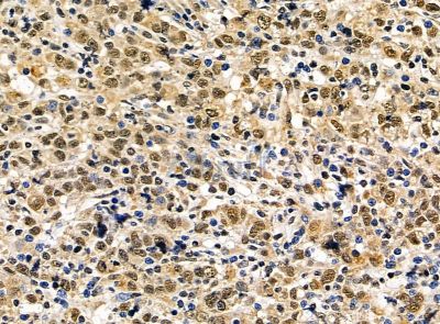 DPY30 Antibody - DF14301 at 1/100 staining human gastric cancer by IHC-P.