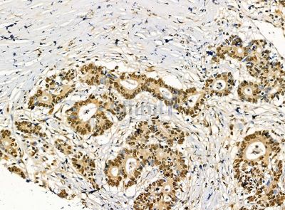 DPY30 Antibody - DF14301 at 1/100 staining human colorectal cancer by IHC-P.