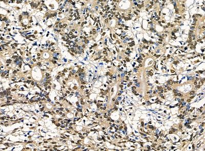 DPY30 Antibody - DF14301 at 1/100 staining human prostate cancer by IHC-P.