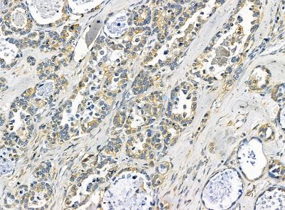 TXNDC6 Antibody - DF14308 at 1/100 staining human ovarian cancer by IHC-P.