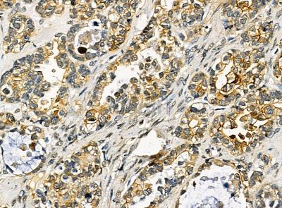 Apc11 Antibody - DF14317 at 1/100 staining human ovarian cancer by IHC-P.