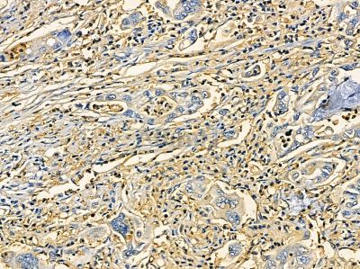 TXNDC4 Antibody - DF14322 at 1/100 staining human gastric cancer by IHC-P.
