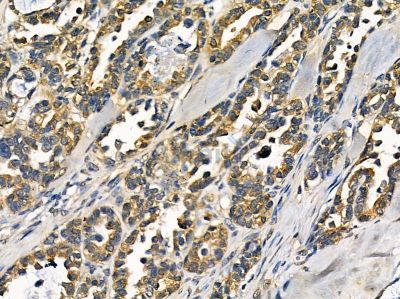 DDX60 Antibody - DF14327 at 1/100 staining human ovarian cancer by IHC-P.