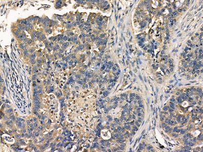 FBXL5 Antibody - DF14329 at 1/100 staining human lung cancer by IHC-P.