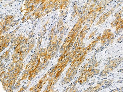 CPA3 Antibody - DF14338 at 1/100 staining human esophageal cancer by IHC-P.