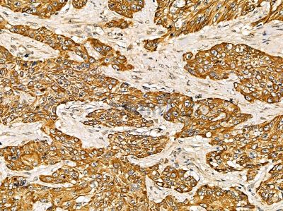 ISG20 Antibody - DF14346 at 1/100 staining human esophageal cancer and para-carcinoma tissue by IHC-P.